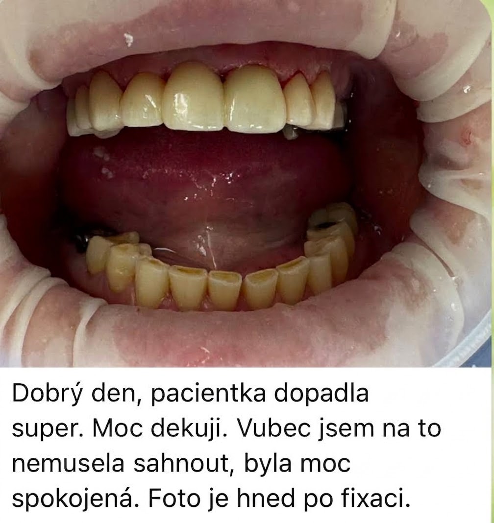 Chrup po zhotovení můstku